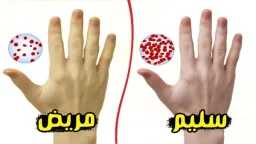 نقص الحديد.. القاتل الصامت الذي...